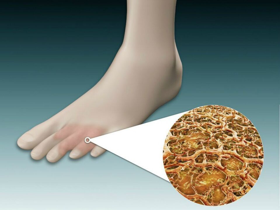 Fungal infection of the foot