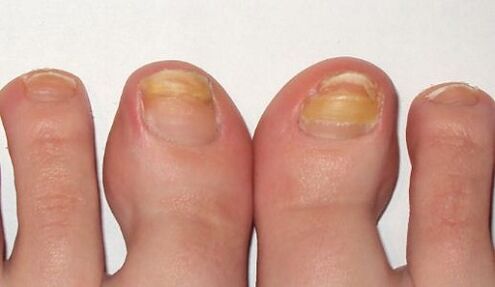 yellowing of toenails with fungus