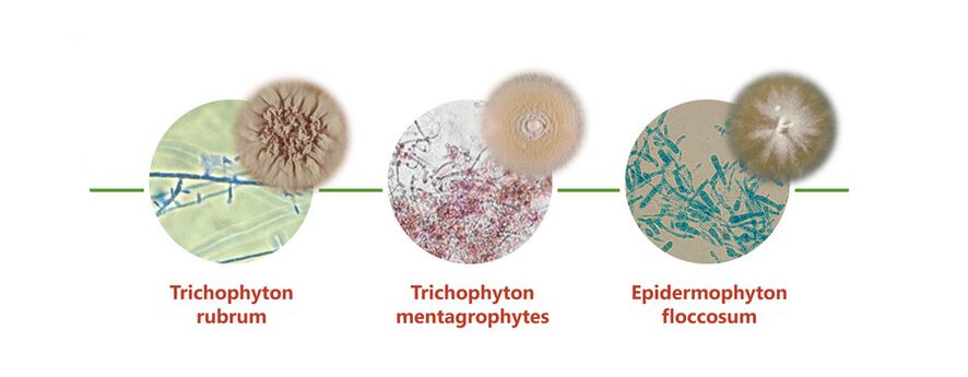 The main causative agents of skin fungus on the feet