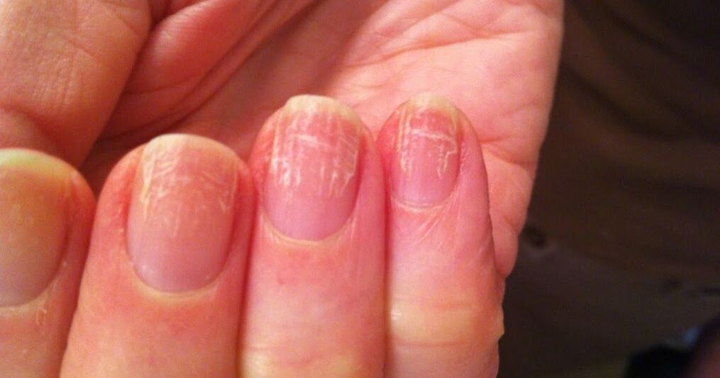 What do nail fungus look like 