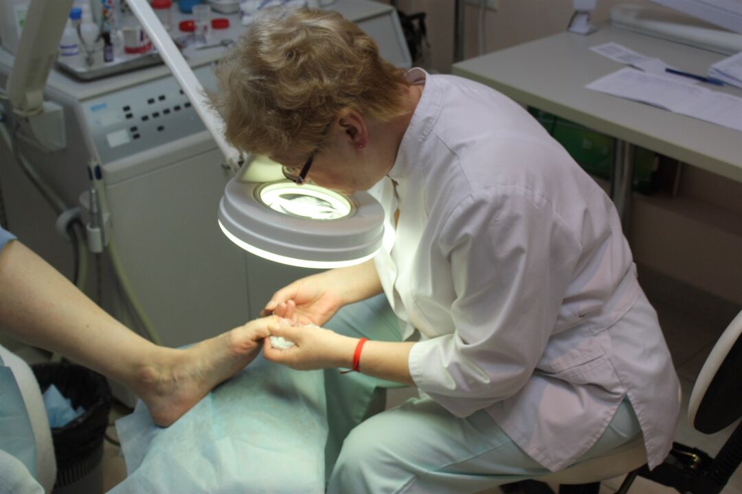 Impressive growth of toenail fungus requires the help of a surgeon